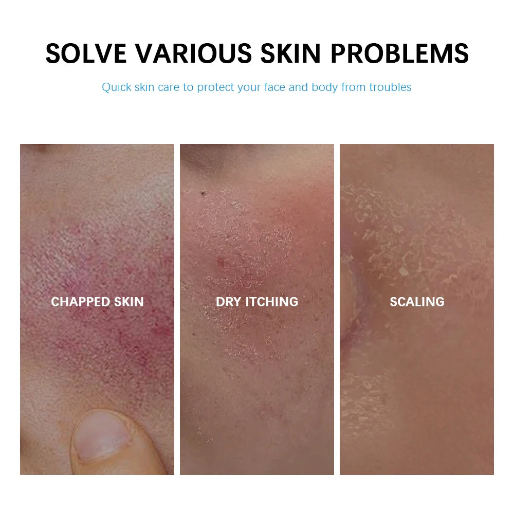 Soothing Multi-Purpose Hydrating Cream Reduces Redness Daily Helps Relieve Rough Cracked Skin Deep Skin Care